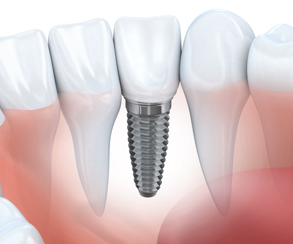 exemplo-de-implante-dental-ou-implantodontia